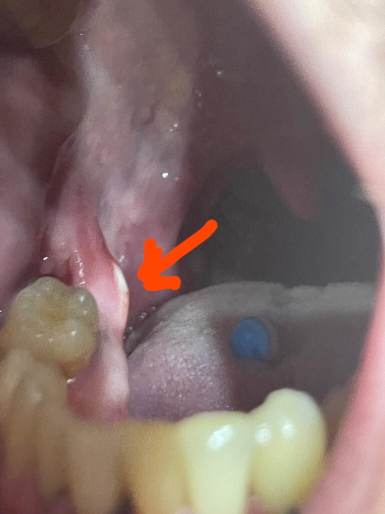 Is It Normal to See Bone After Wisdom Tooth Extraction