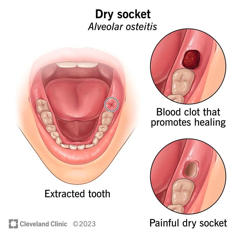 What Does a Wisdom Tooth Dry Socket Look Like