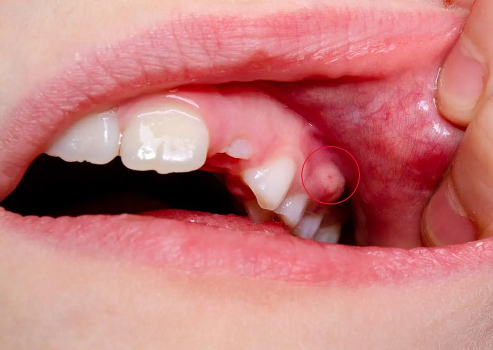 What to Do If Tooth Abscess Pops