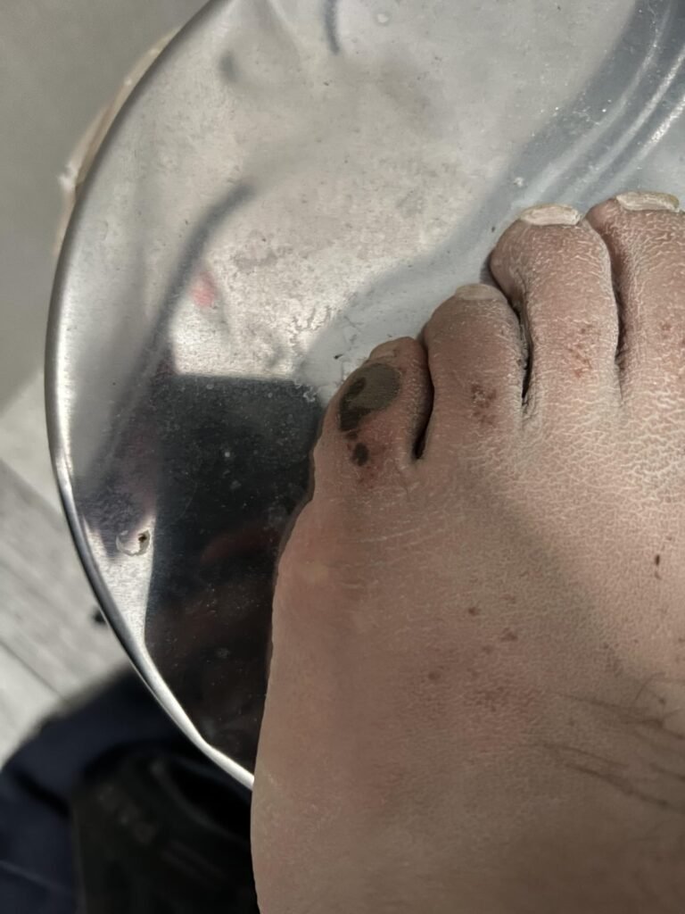 How Get Cement off Skin